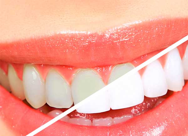 Falsos mitos sobre odontología: El blanqueamiento dental debilita los dientes: